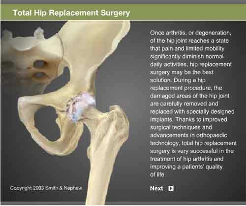 knee replacement screenshot
